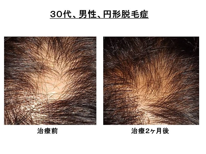 円形脱毛症　病院""